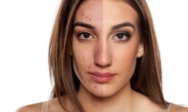 Keloid Removal Surgery